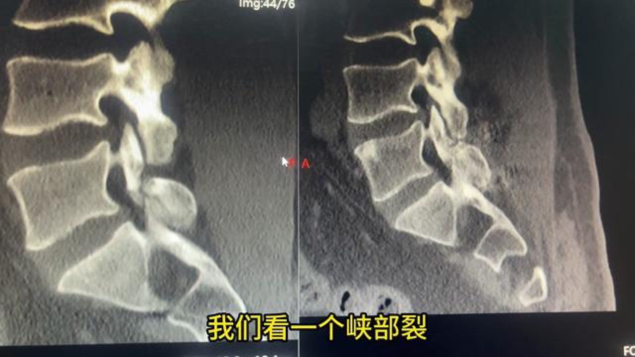 历经2年，峡部裂终于愈合了！ #腰痛 #峡部裂 #腰椎滑脱 #医学科普 #脊柱微创杨文成