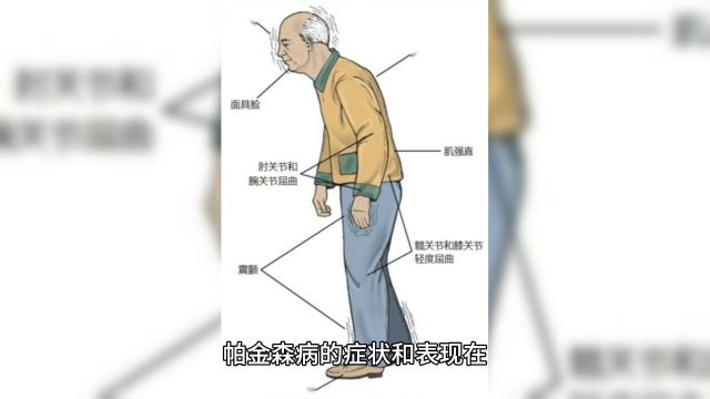 个性化治疗方案的魅力:如何为帕金森患者带来更好的生活质量