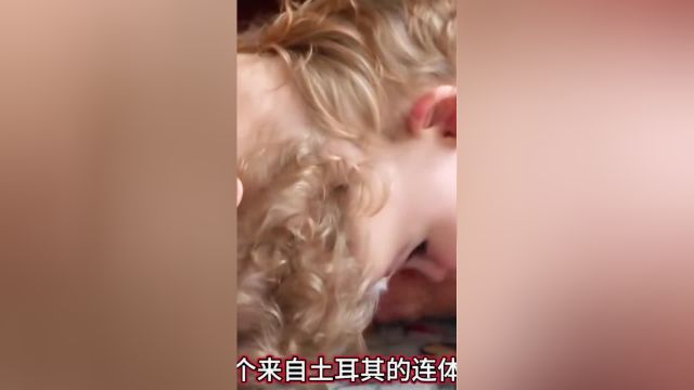 连体婴儿的真实故事连体婴儿连体人真实记录精彩片段连体双胞胎