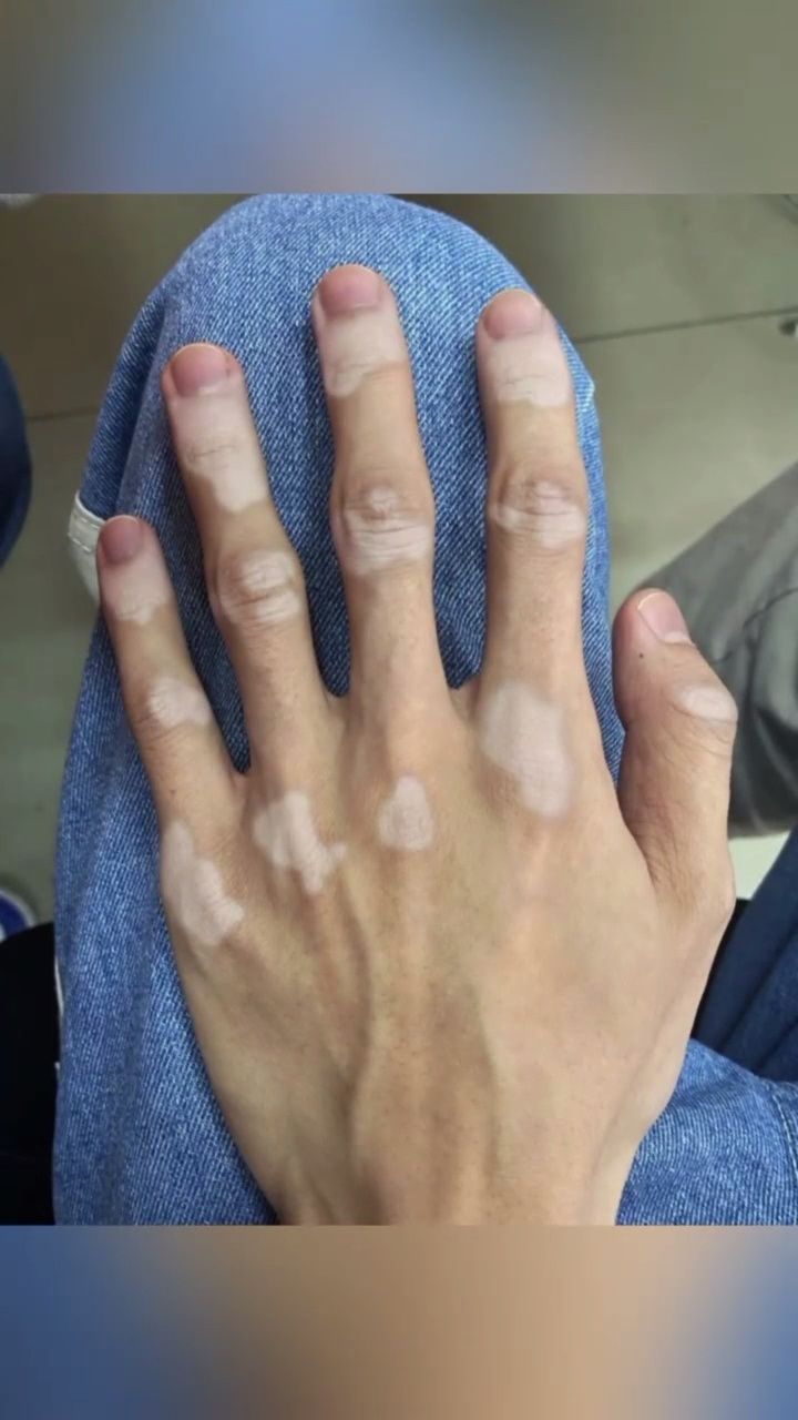 手上的白癜风不见啦