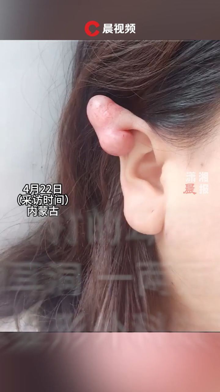 女子两年前打耳洞,孕期出现增生,"手术费近2万!