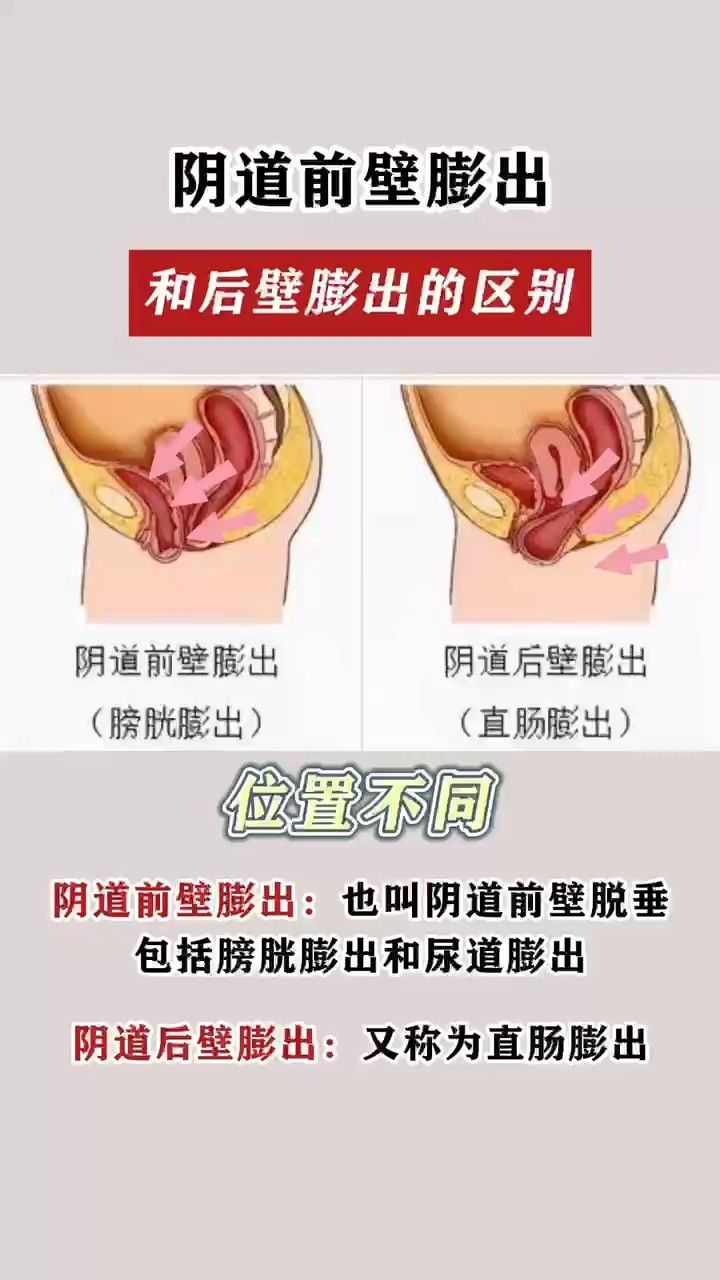 大连美琳达妇产-都是子宫脱垂为什么还有前壁膨出和后壁膨出之分