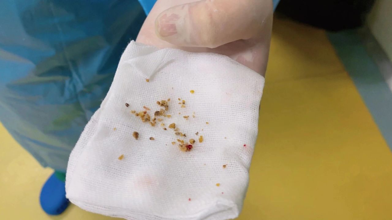 成都肾结石取石案例:纤维软性肾镜碎石后取出的肾结石,一起瞧瞧