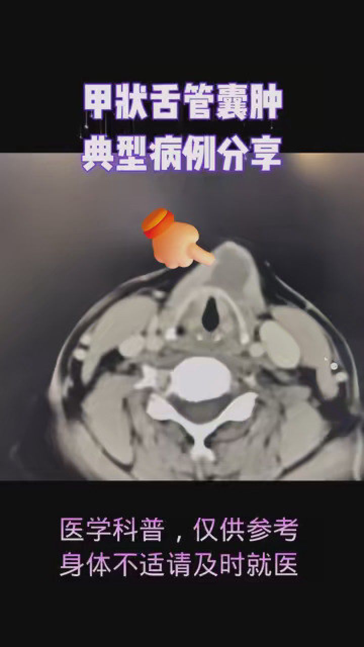 #医学影像#甲状舌管囊肿#颈部CT颈部甲状软骨前方的低密度囊样肿块,一般都是甲状舌管囊肿!_高清1080P在线观看平台_腾讯视频