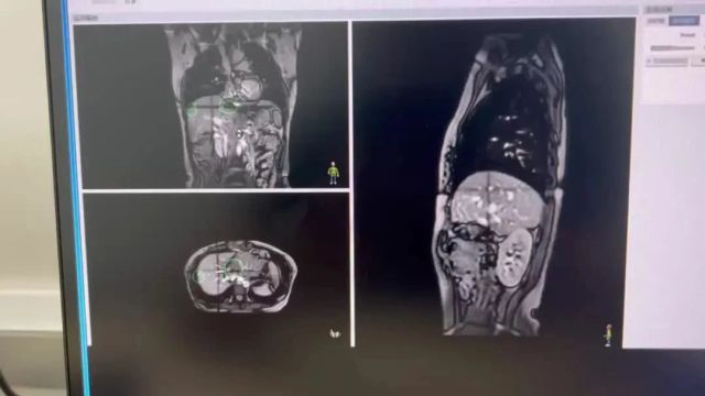 华西医院:MRI引导放疗系统临床上线