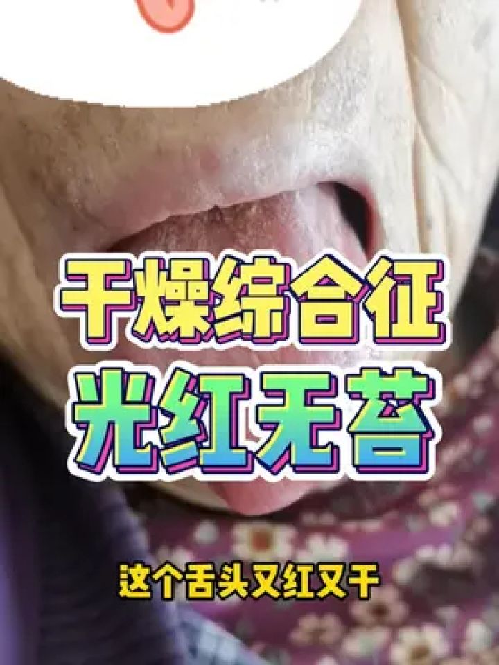 干燥综合征 光红无苔 #干燥综合征 #中医