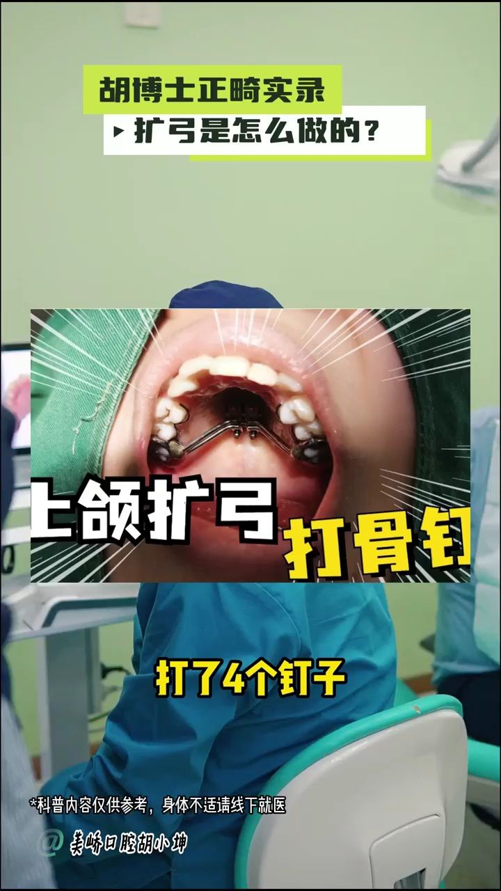 南京牙齿矫正胡小坤博士(美峤口腔)——扩弓是怎么做的?