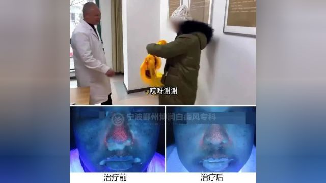 【宁波白癜风医院哪家好】“医者仁心,大爱无疆”“感谢刘锐主任帮我复色”2024宁波博润陪您复色!