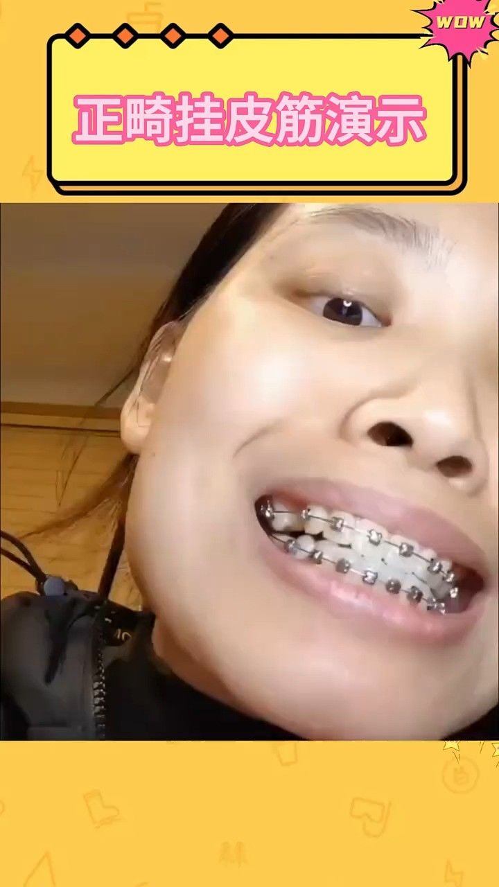 正畸挂皮筋演示!谁懂啊,挂皮筋的时候一个不小心还会弹到嘴巴,那酸爽?