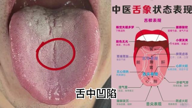 今日舌象分析——舌中凹陷,舌根舌苔白腻——肾阳虚、脾胃虚
