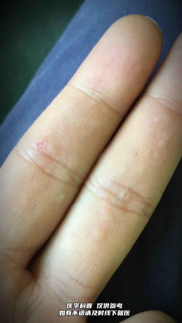 汗疱疹让女性手部瘙痒难耐,水疱挠破流出不明液体,反复发作.