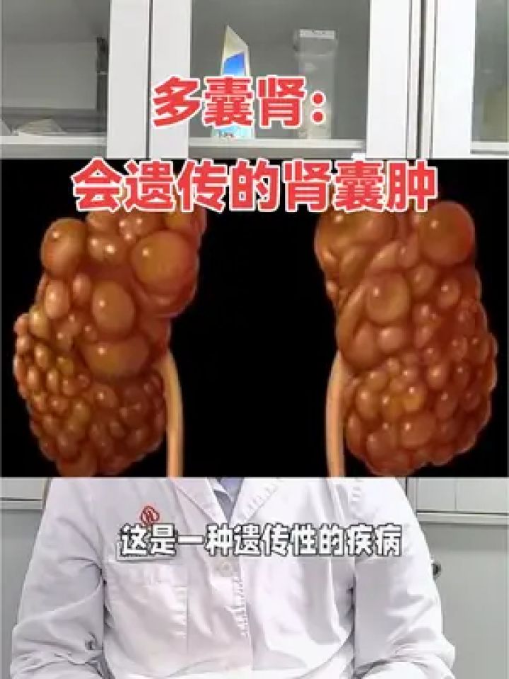 多囊肾,会遗传的肾囊肿#肾囊肿到底严不严重 #多囊肾 #多囊肾会遗传吗