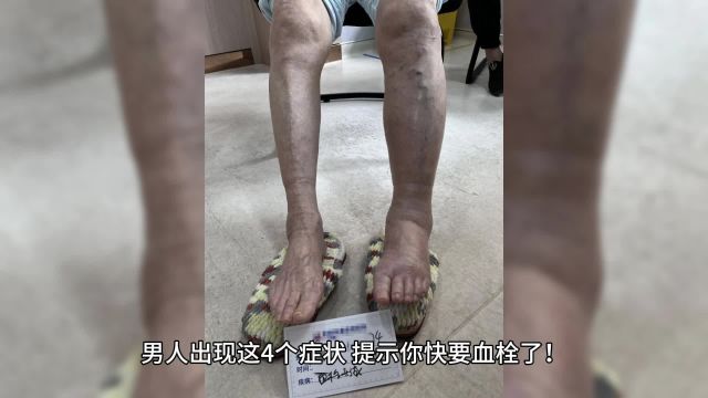 男人出现这4个症状,提示你快要血栓了!