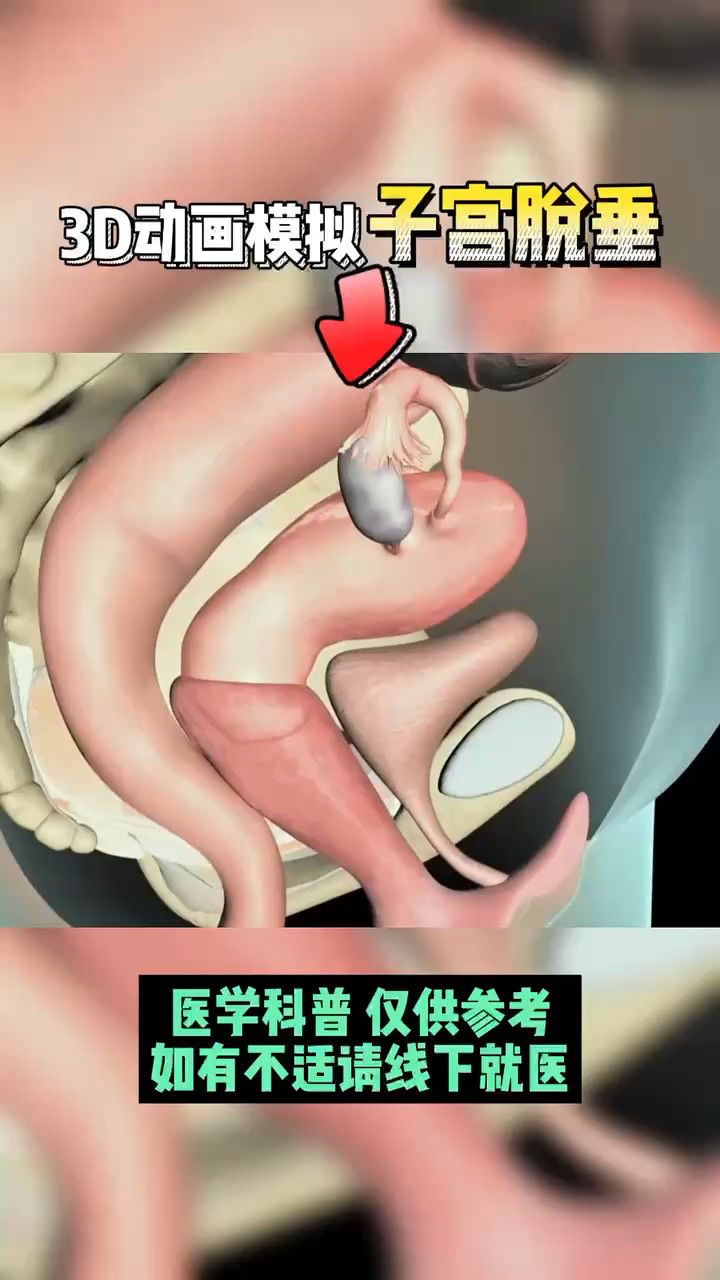 大连美琳达妇产-子宫是怎么一点点掉下来的子宫脱垂一定要重视!
