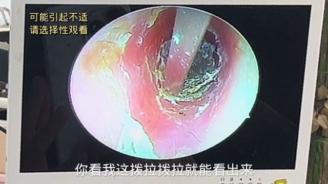 什么样的耳朵都有,一定要定期清理耳朵哈