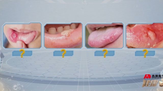 根据这四种状态,让你分辨口腔溃疡和口腔癌前病变!