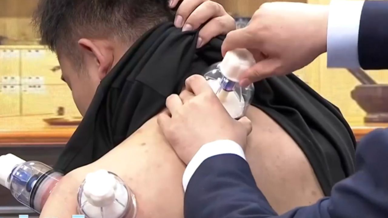 颈肩疼可以在家这样拔罐,仅需十分钟,就能有效缓解疼痛