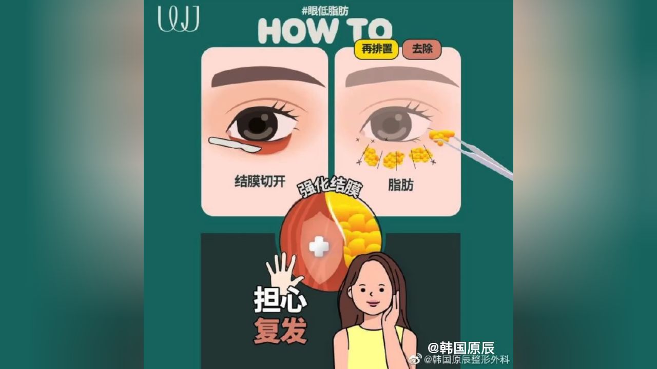 明明很年轻,却被恼人的眼袋加大年龄 试试wj原辰整形外科眼底脂肪