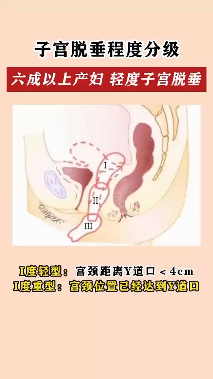 大连美琳达妇产-子宫脱垂也分度来看看你是否有以下症状