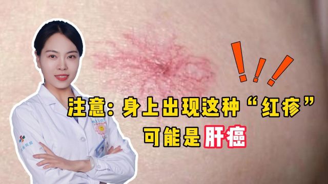 注意!身上出现这种“红疹”,可能是肝癌!