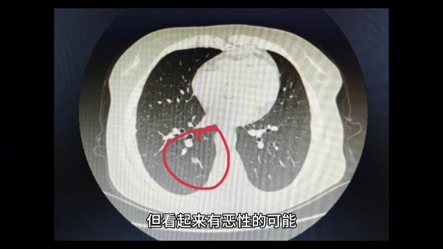 刘懿博士说肺癌(七五六八)CT报告肺磨玻璃结节边界模糊会是癌么