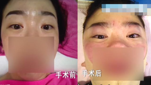 女子花7万整形后像猪脑袋,公司人脸识别也失效,医院:正常情况