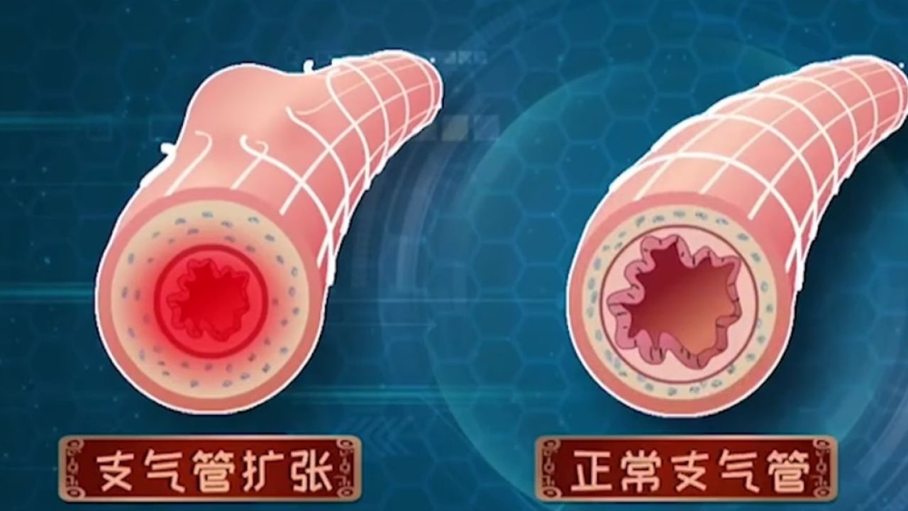 黄绿痰多见于绿脓杆菌的感染,常见于支气管扩张的患者_高清1080P在线观看平台_腾讯视频