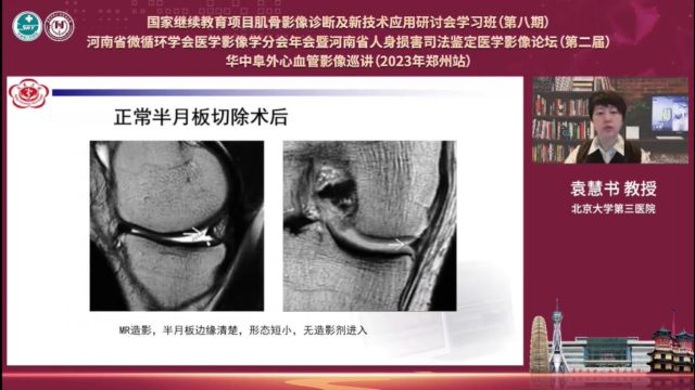 MR关节造影剂临床应用北京大学第三医院袁慧书