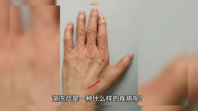 渐冻症的具体病因目前尚不明确,主要的病理改变是大脑的运动神经元进行性退化.渐冻症的症状包括肌肉无力、肌肉萎缩、肌肉跳动或颤动等,