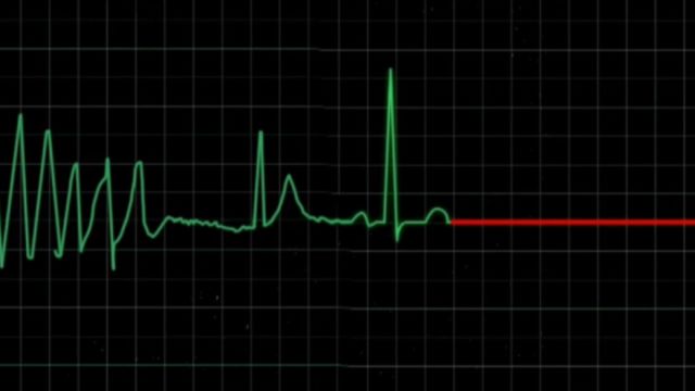 室颤是非常恐怖的一种心律失常,现在经常听到的猝死就是它