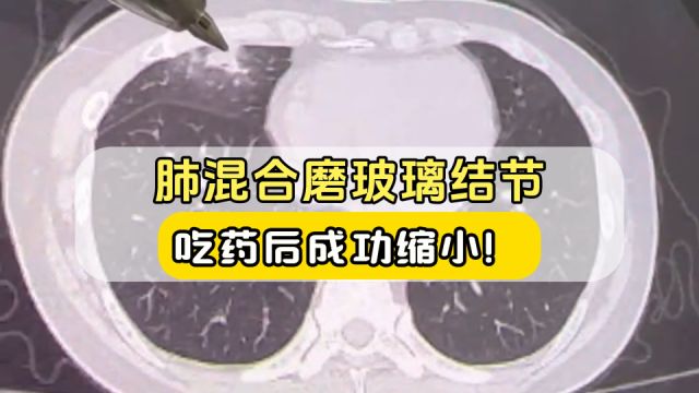 肺混合磨玻璃结节,吃药后消失!到底怎么回事?