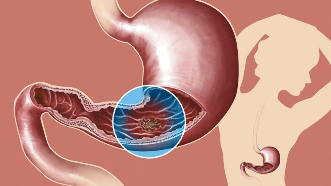 十二指肠溃疡的"罪魁祸首"被揪出,这4个诱因,都要及时避开