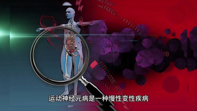 运动神经元病是指选择性损害脊髓前角、桥延脑运动神经核和锥体束的慢性变性疾病,什么是运动神经元病?临床以上或(和)下运动神经元损害