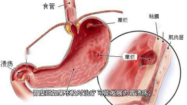 曹文兰胃溃疡和胃糜烂是一样吗