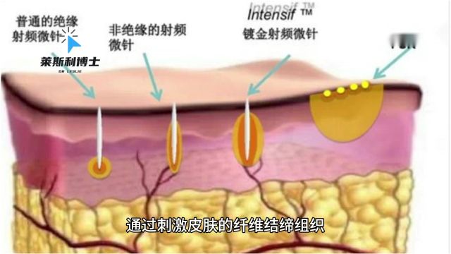 为什么不建议做黄金微针、黄金微针的功效和作用谁了解~