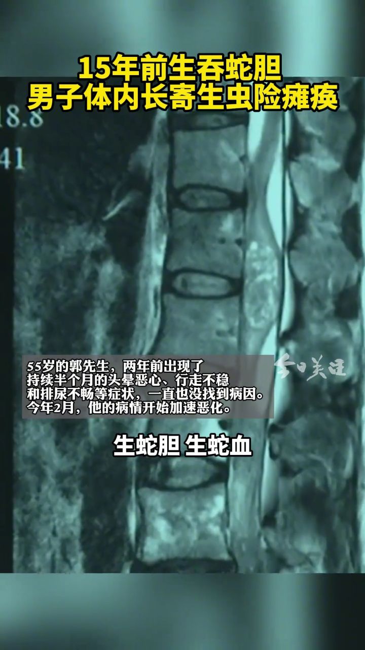 男子怪病缠身险瘫痪,元凶竟是15年前"生吞蛇胆"