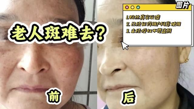 老人斑难去?藏在药房的“小软膏”见到就拿下 ,一涂一抹斑点拜拜