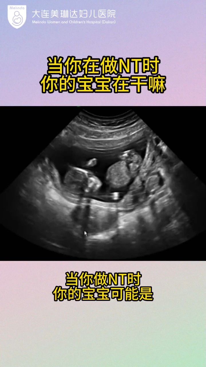 大连美琳达妇产,做nt时宝宝的真实写照做超声检查首选,nt检查
