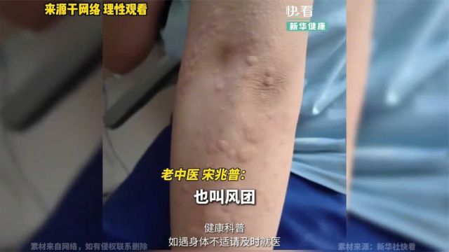 身上起荨麻疹、瘙痒怎么办?老中医分享家庭养疗小配方