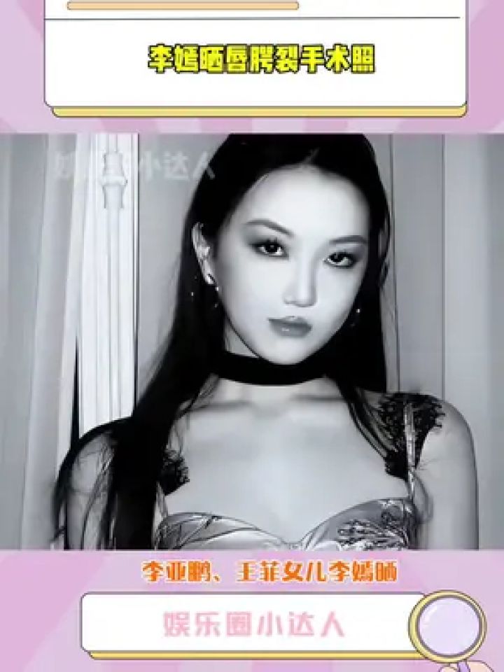 李亚鹏#王菲 女儿#李嫣 晒唇腭裂手术照,发文轻舟已过
