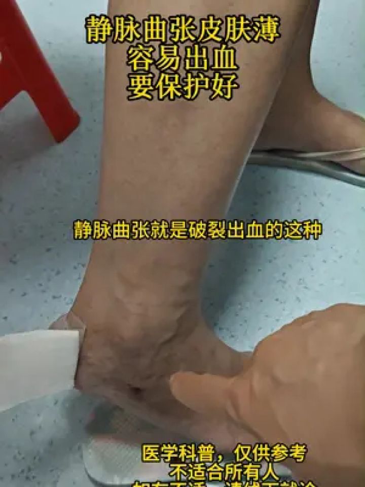 腿部静脉曲张怎么治疗图片