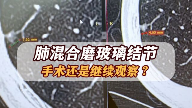 肺混合磨玻璃结节,随访不变化也没危险!有2条路可选择