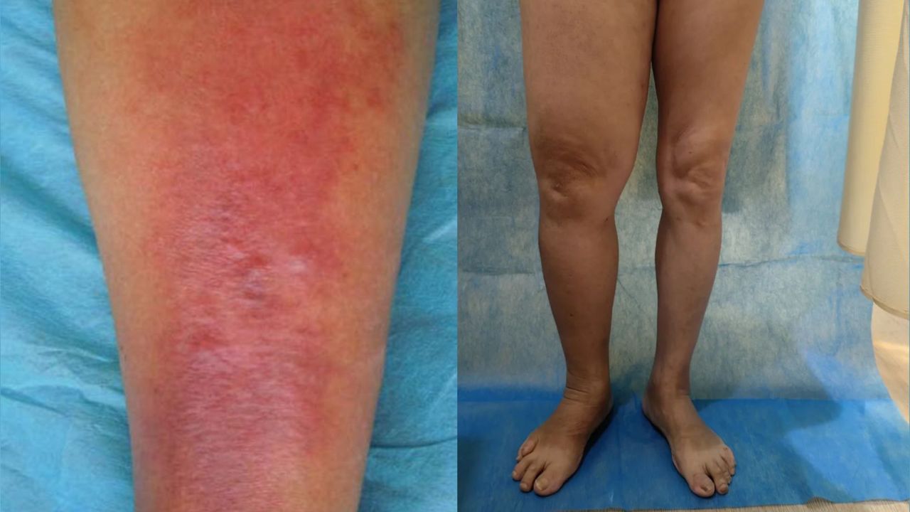 女子冬天被蚊子叮一口,整条腿红肿染上丹毒,医生:有宫颈癌史