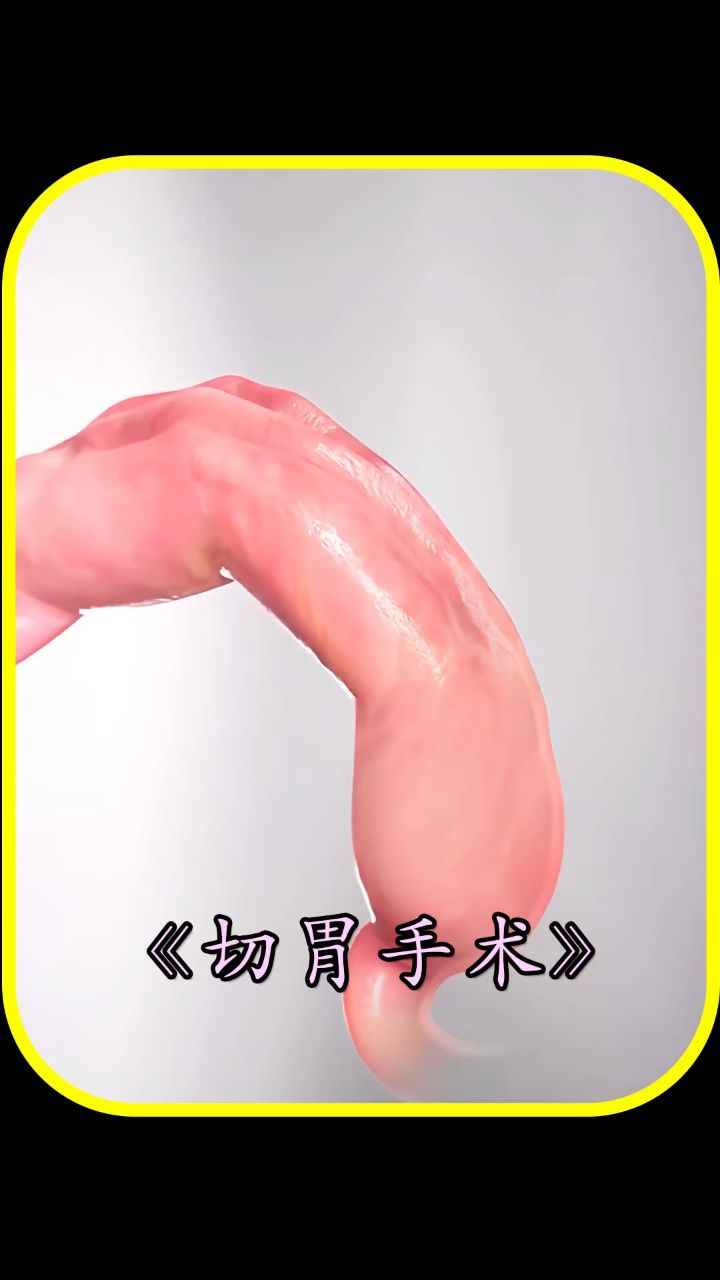 切胃手术的过程是这样的