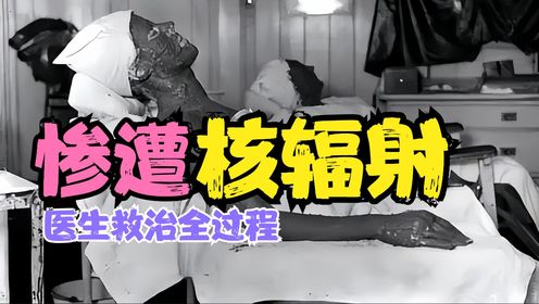 一位核辐射感染者,被医生强行救治83天,最后全身溃烂痛苦离去