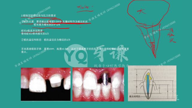 24年牙谦教育王旭口腔医师口腔修复学牙体缺损