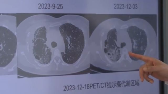 全国肿瘤防治宣传周,肺癌是我国发病率和死亡率最高的恶性肿瘤