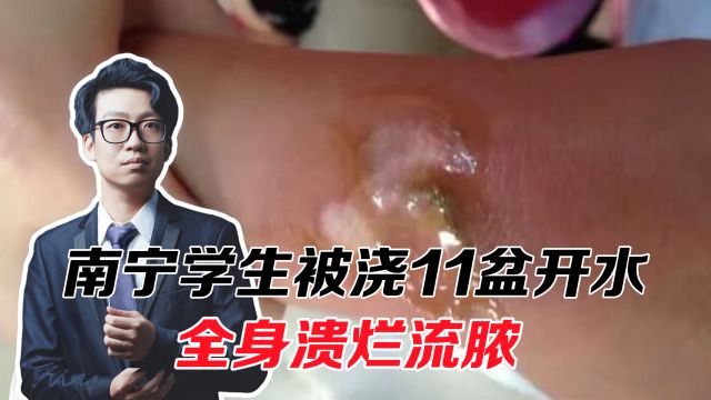 南宁学生被浇11盆开水,全身溃烂流脓,老师家长在干嘛?