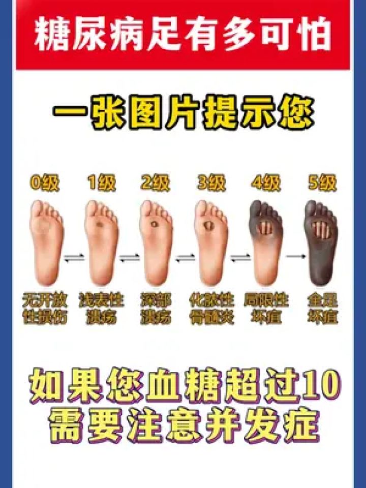 糖尿病足 #血糖 #糖尿病 #硬核健康科普行动