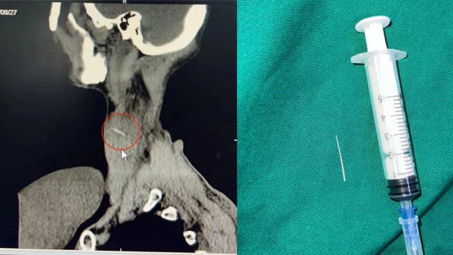 男子颈部突然长“大包”,20多天疼痛不已,竟是一根鱼刺惹祸
